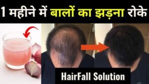 1 महीने में बालों का झड़ना रोके | Hair Loss Solution in Hindi